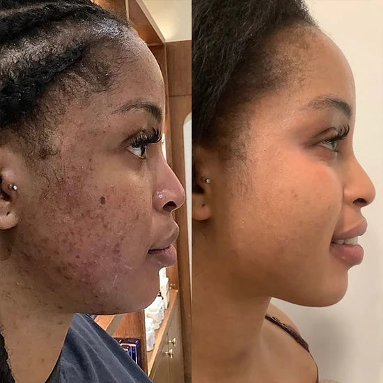 Kojic Acid and Turmeric Cleansing Pads